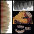 Implant Supported Maxillary Rehabilitation