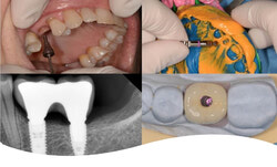 2026 will be the 23rd year of our introductory implant placement program